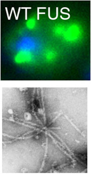 Yeast expressing FUS. Note the presence of FUS clumps in the cytoplasm (green foci) and the position of the nucleus (blue). Electron microscopy of clumps formed by pure FUS in the test tube (bottom). Credit: Aaron Gitler, PhD; James Shorter, PhD; University of Pennsylvania School of Medicine
